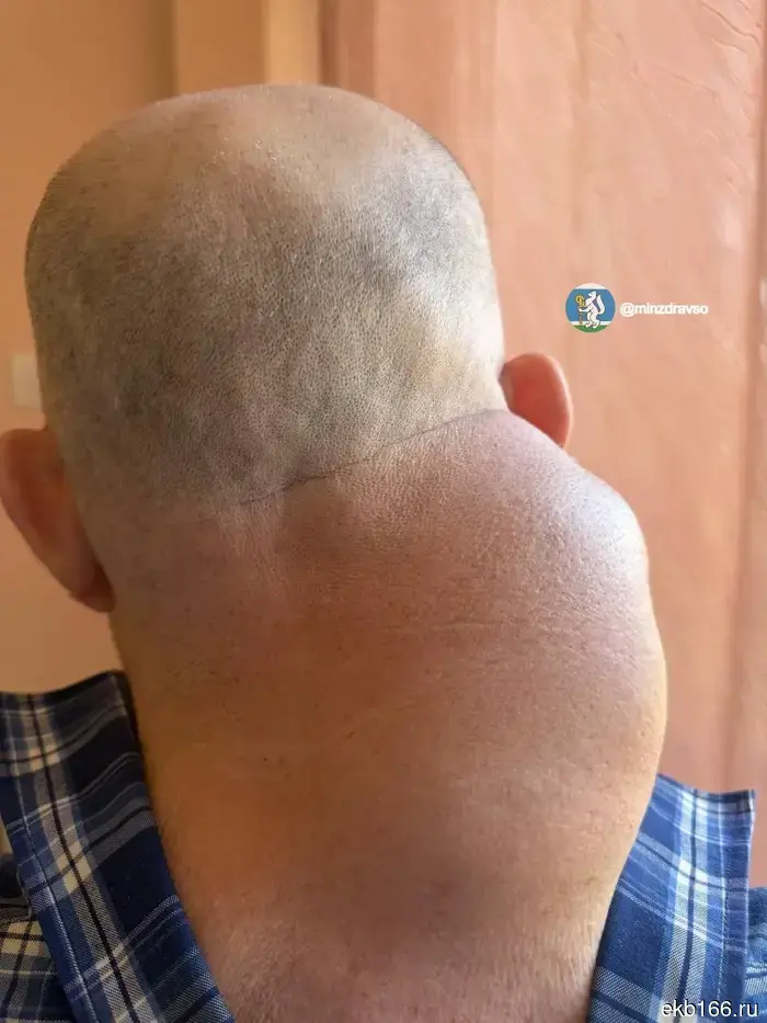 A resident of Yekaterinburg was freed from a tumor that disfigured his neck (PHOTO)