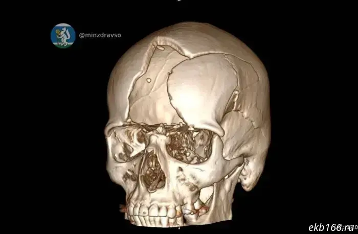 Sverdlovsk doctors reconstructed a man's skull who suffered severe injuries during the special military operation.