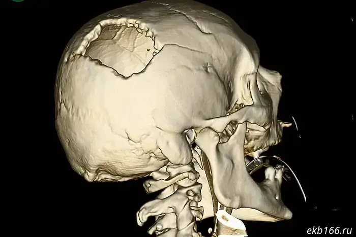 The boom of a tower crane pierced the skull of a man from Sverdlovsk.