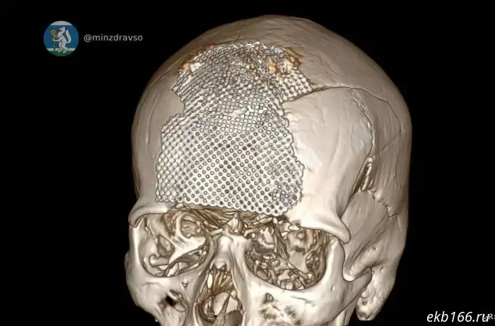 Sverdlovsk doctors reconstructed a man's skull who suffered severe injuries during the special military operation.