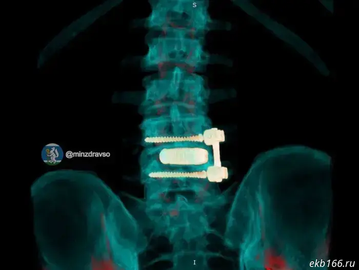 An infection nearly destroyed the spine of a Sverdlovsk ambulance driver.