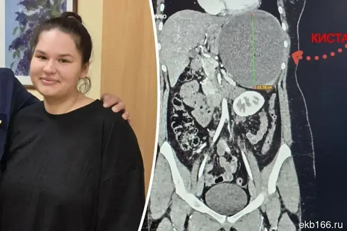 Doctors removed a cyst the size of a watermelon from a 20-year-old woman from Yekaterinburg.