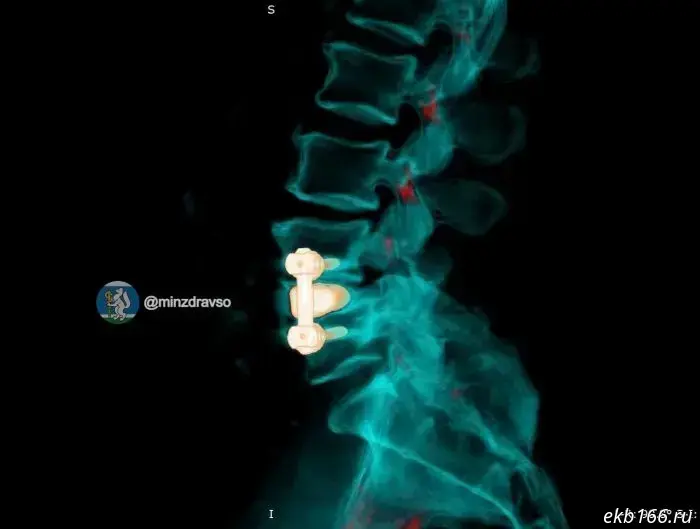 An infection nearly destroyed the spine of a Sverdlovsk ambulance driver.